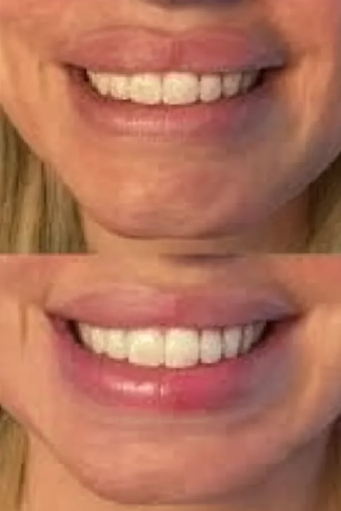 Belissas Whitening före och efter