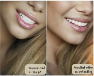 Dentway tandblekning före och efterbild